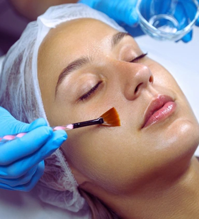 Chemical Peel Treatment