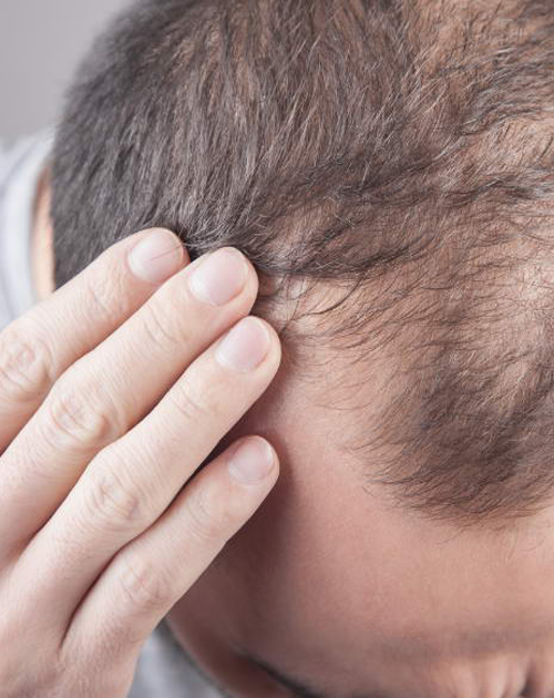 Hair Fall Treatment