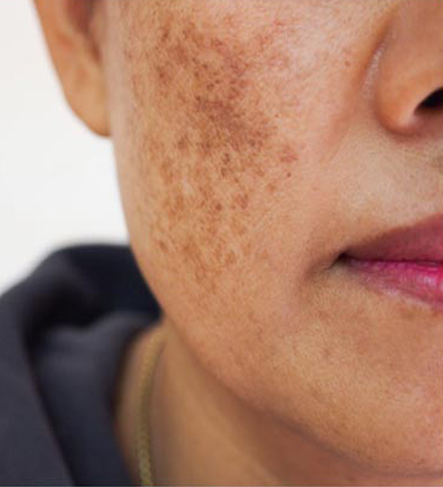 Pigmentation Treatment