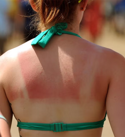 Sunburn Treatment